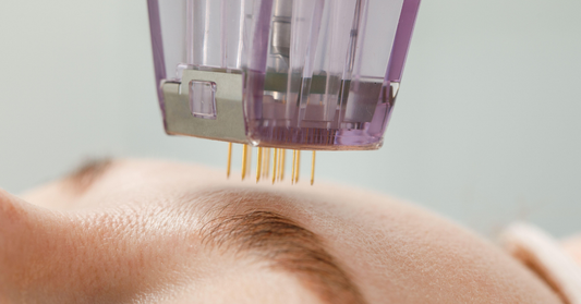 Is RF Microneedling Worth It? A Former Medical Esthetician Shares the Real Deal