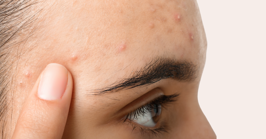 How To Clear Teenage Acne